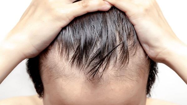 ¿Cómo funciona Saw Palmetto para la pérdida de cabello (AGA)?